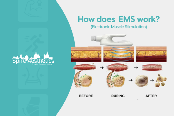EMS treatment for post pregnancy weight loss treatment Dunstable
