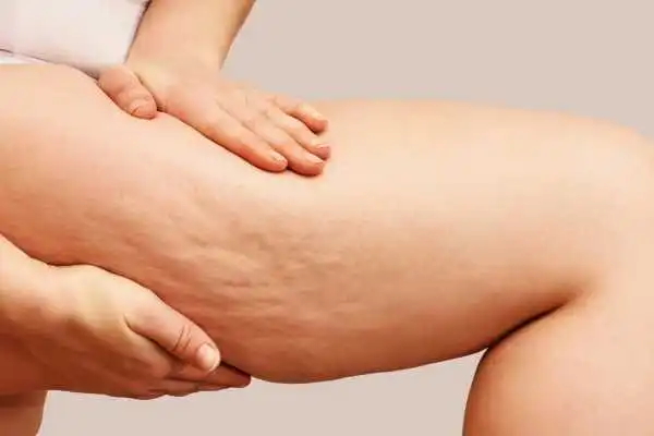 Image of woman showing leg with cellulite Dunstable