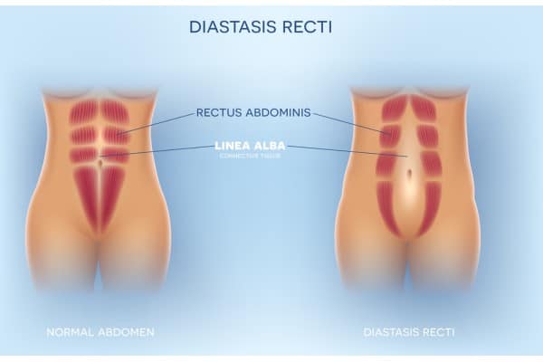 What Non-Surgical Options Are Available for Diastasis Recti Dunstable?
