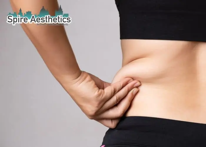 Image of woman pinching fat on their hips Dunstable. Fat Freezing treatment