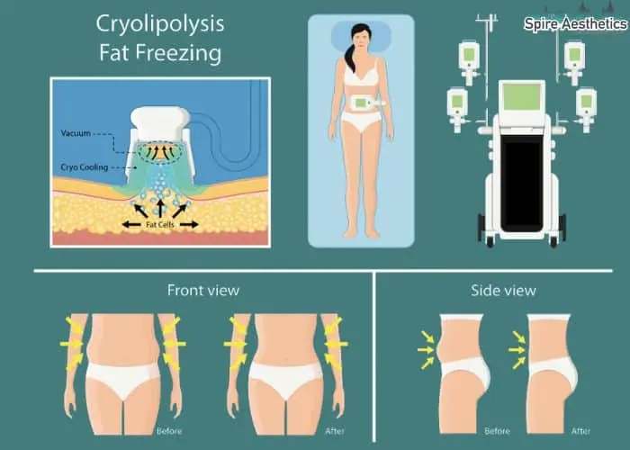 Fat freezing treatment Dunstable benefits for competitions to remove stubborn fat deposits.