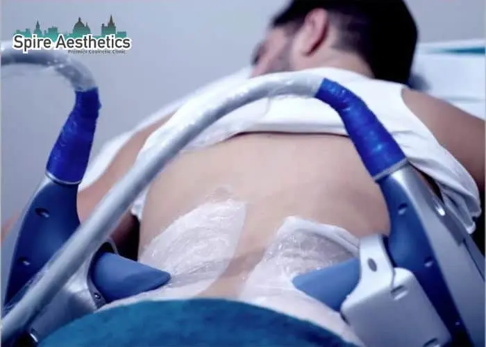 Man having fat freezing treatment done on love handles before a competitions Dunstable to create a sculpted look.