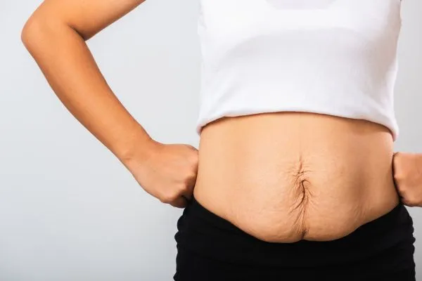 Image of a woman's stomach after weight loss with sagging skin following a gastric band Dunstable
