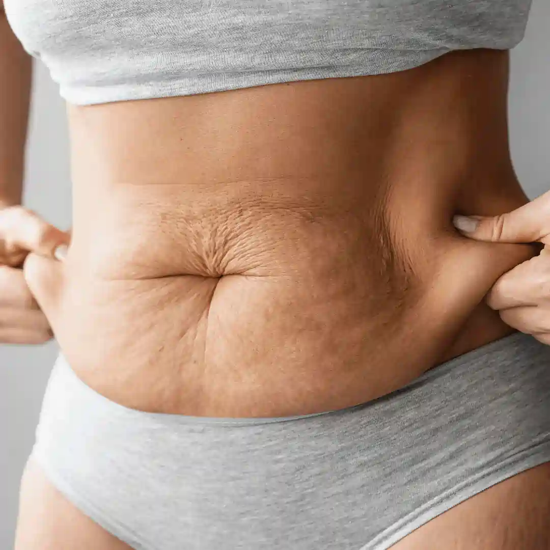 Is It Normal to Have Loose Skin After Pregnancy Dunstable?