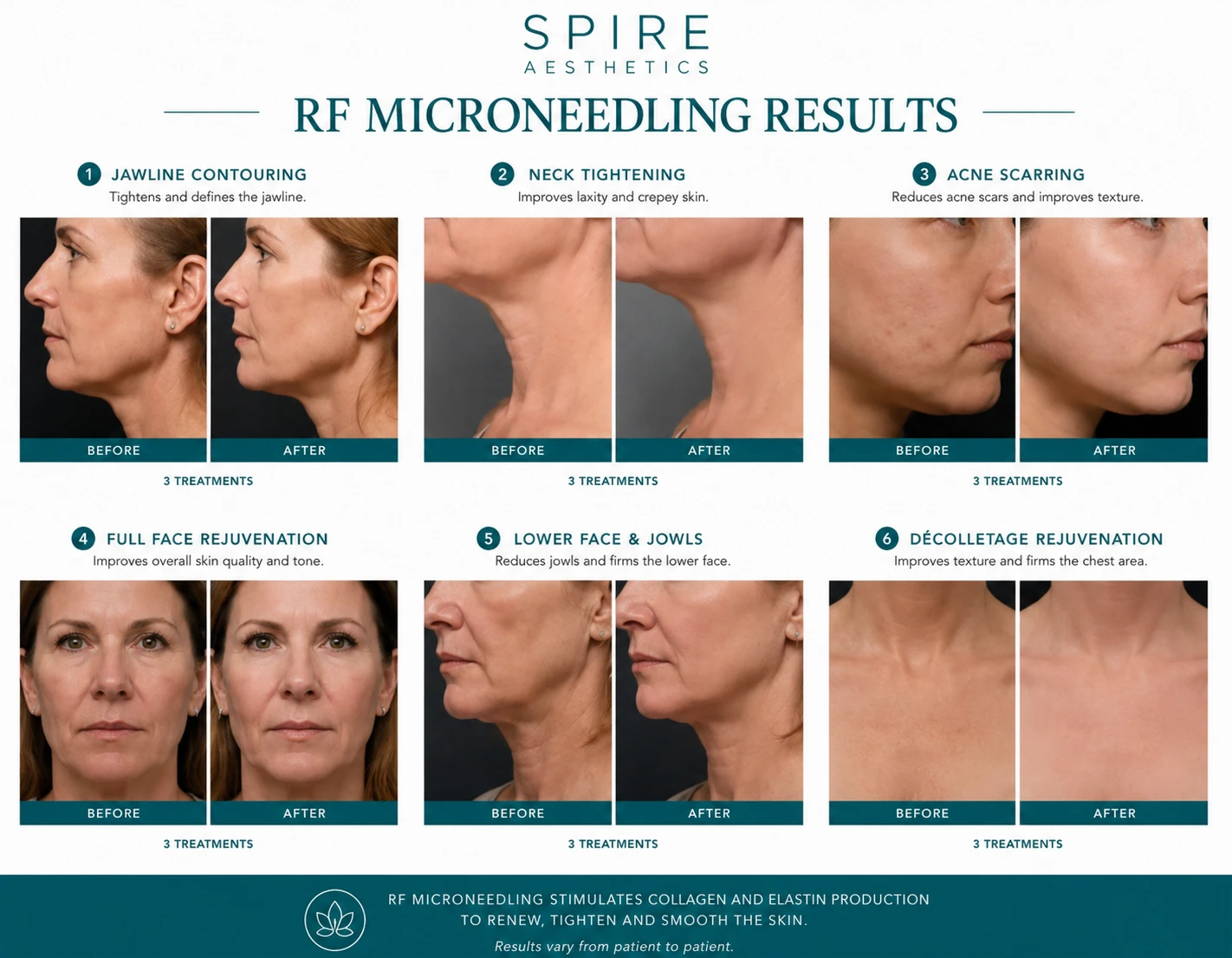 RF Microneedling Skin tightening Dunstable results