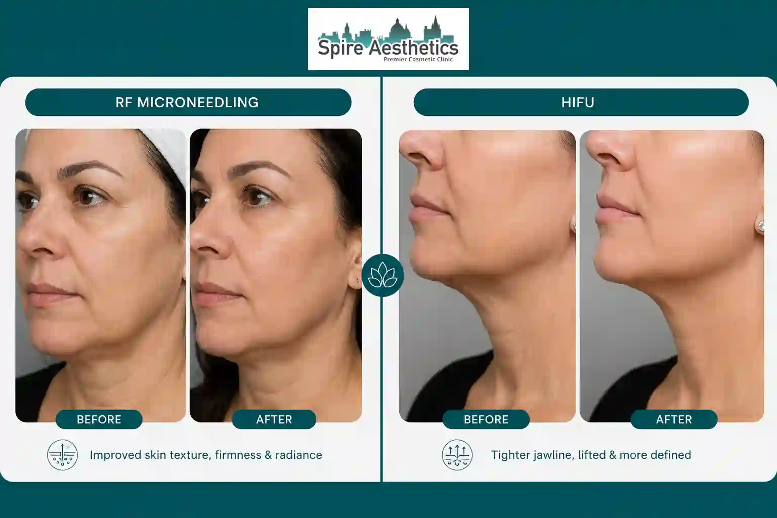 Can RF Microneedling and HIFU Be Combined Dunstable?