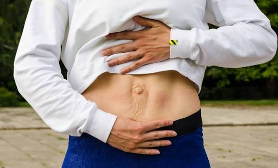 When Could Diastasis Recti Be the Missing Piece of the Puzzle Dunstable?