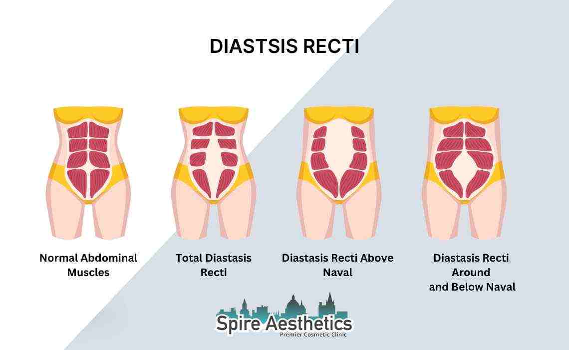 Is Non-Surgical Diastasis Recti Treatment Right for You? Common Concerns Answered Dunstable